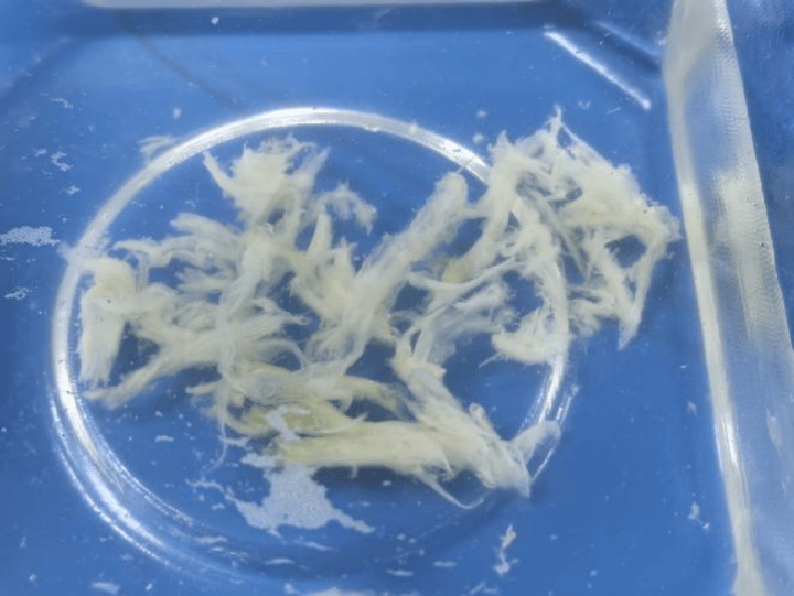 皇冠信用网正版
_发热一天就病危皇冠信用网正版
!11岁男孩肺里长出“死亡树杈”