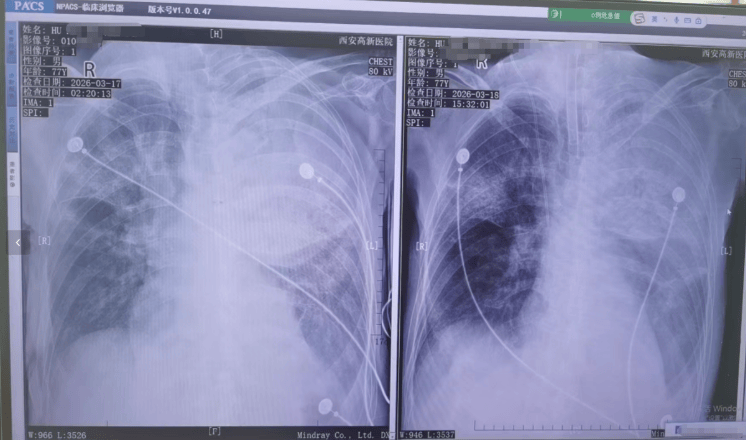 世界杯真钱开户
_男子在陕西一景区套圈套中鹦鹉带回家饲养世界杯真钱开户
,鹦鹉死后父亲感染“鹦鹉热”,“整个肺部全白了”;医生:潜伏期5至14天,早期表现类似流感