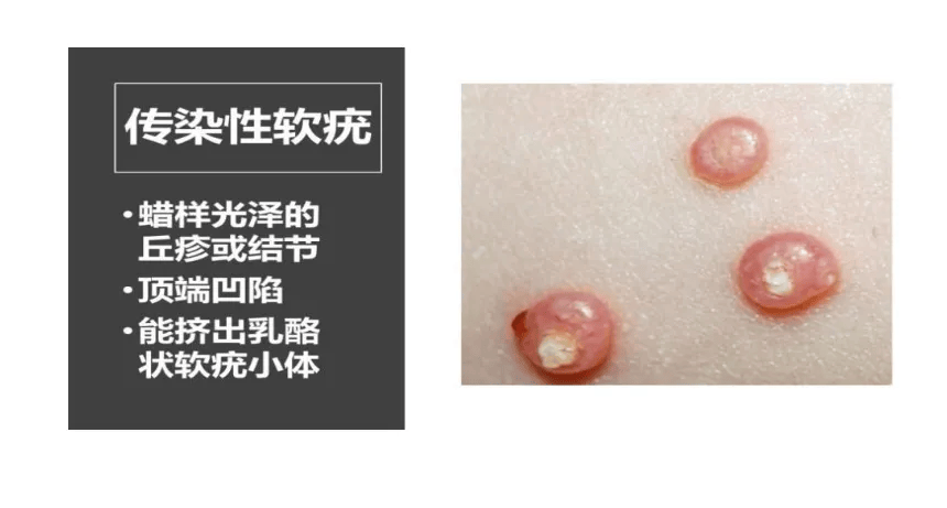 皇冠app_女孩游泳20多天全身长20多个疣！医生提醒：泳池是传播高危区皇冠app，千万别用手挤