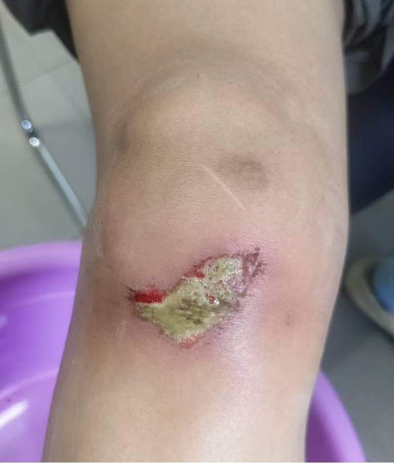 立陶宛乙组联赛_杭州35岁女子环洱海骑行时摔破皮立陶宛乙组联赛，用自来水冲了冲伤口，回家后高烧近40℃，紧急送医